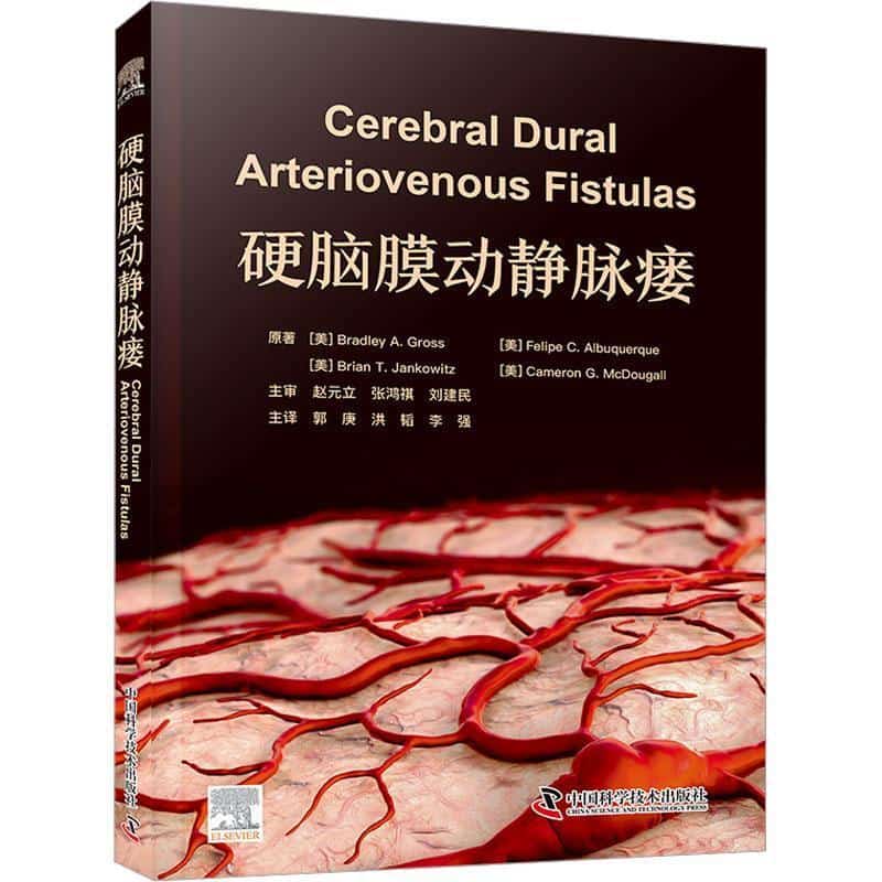 硬脑膜动静脉瘘