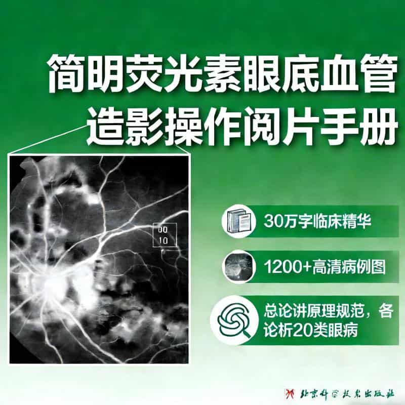 简明荧光素眼底血管造影操作阅片手册